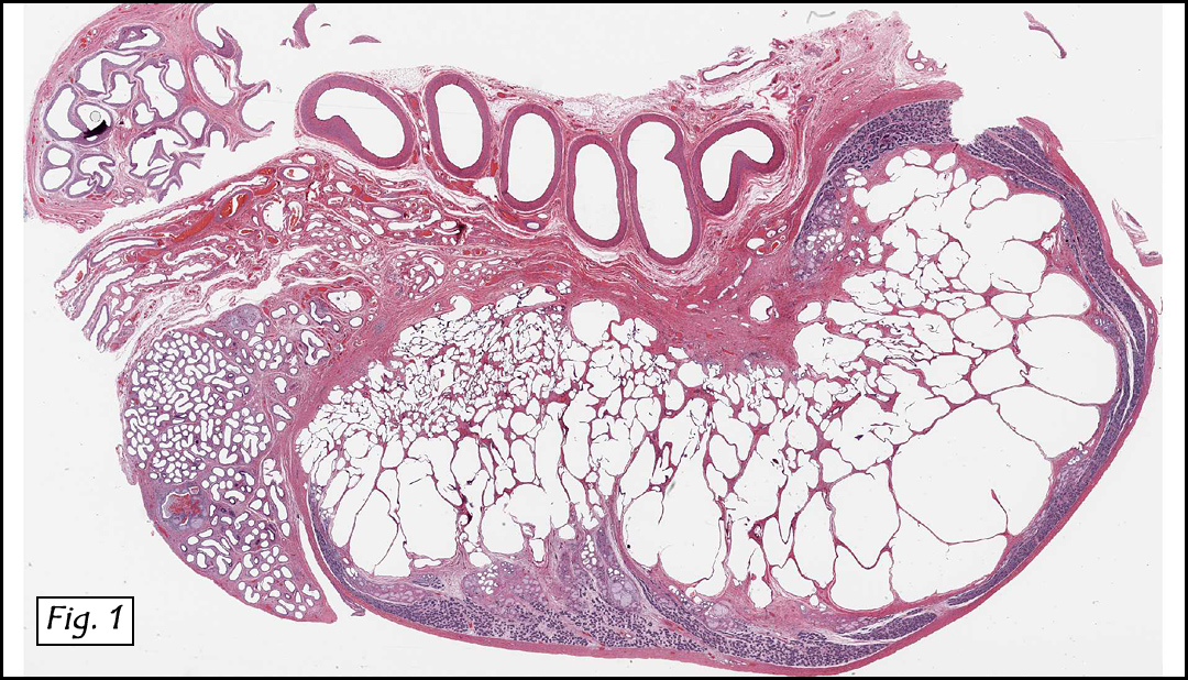 History A threeyearold boy underwent orchiectomy for a cystic scrotal 