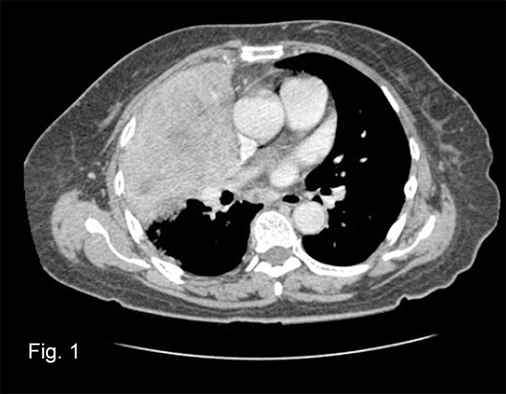 July 2014 A Large Lung Mass In A 69 Year Old Woman From South Asia 