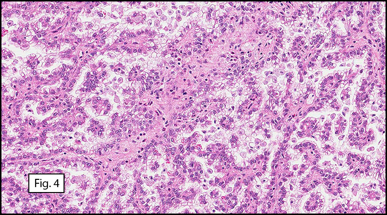 October 2012: A 61 year old woman with a left kidney mass – California