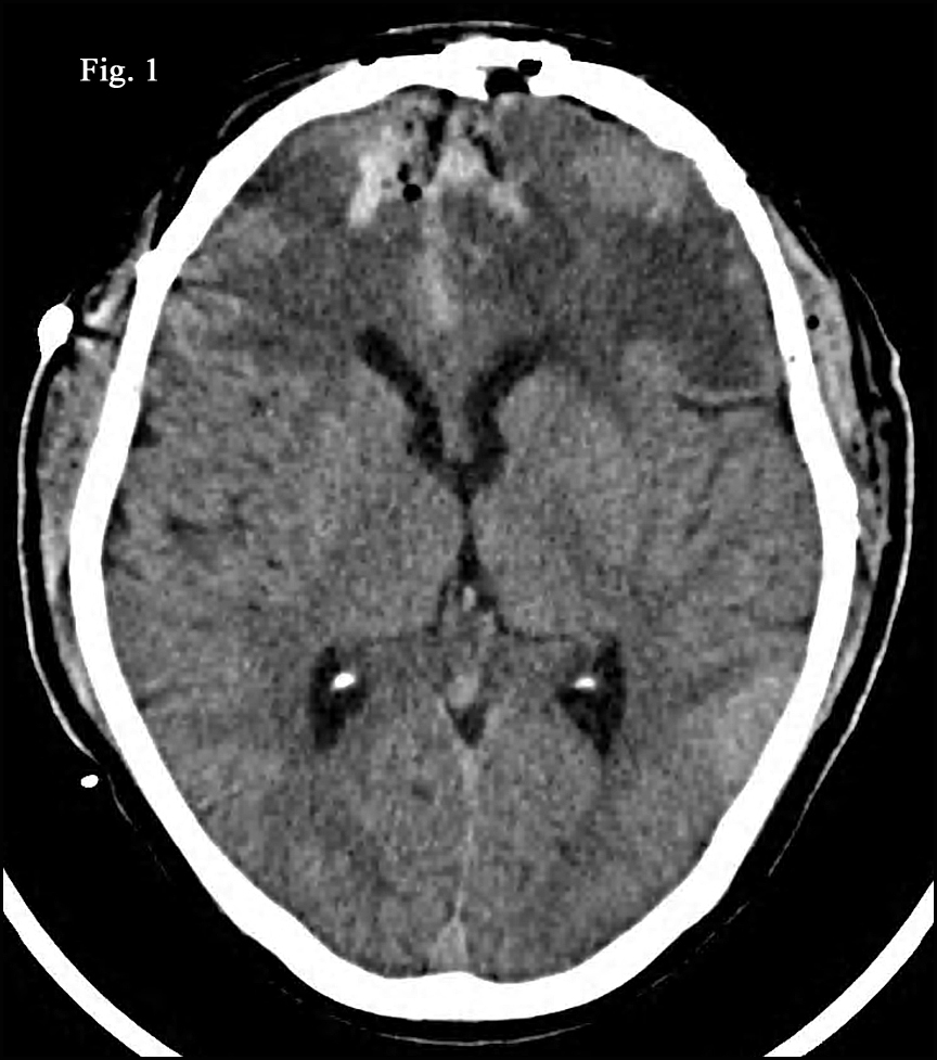 Brain Mri Tumor