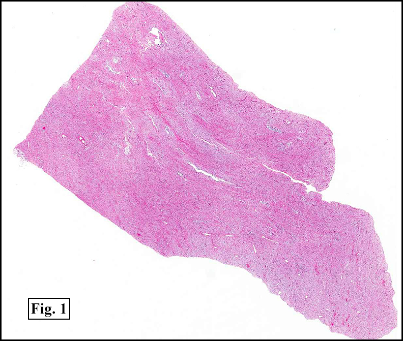 December 2012: A 13 month old boy with a chest wall mass – California Tumor  Tissue Registry